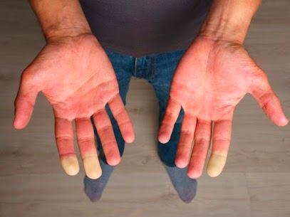 enfermedad de raynaud