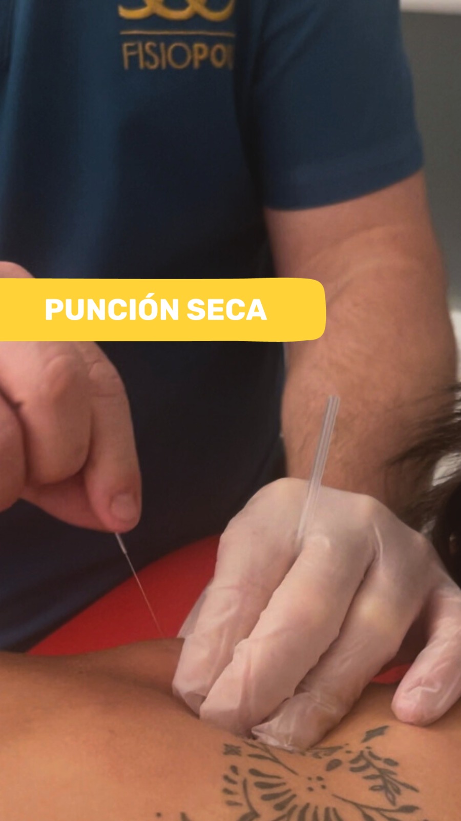 punción seca