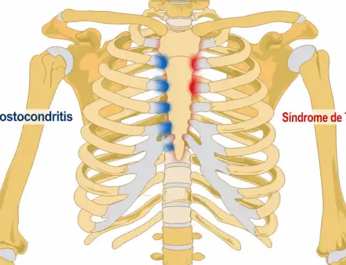 Costocondritis o Síndrome de Tietze: Todo lo que Debes Saber